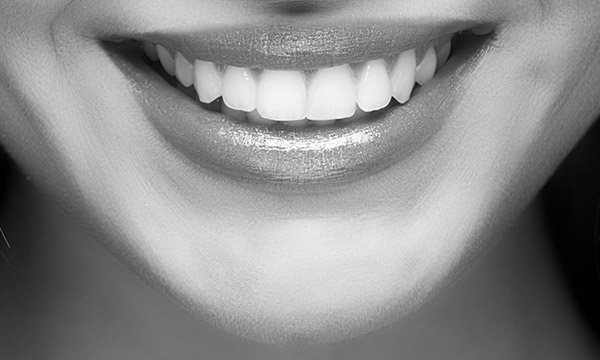 Améliorer votre sourire avec les facettes dentaires